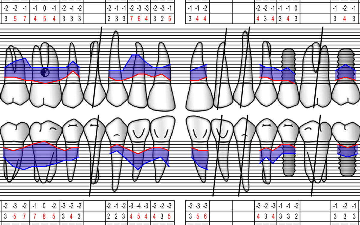 Periodontal Charting